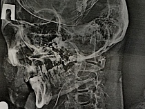 Калининградский грабитель и угонщик сломал челюсти жителю Светлогорска