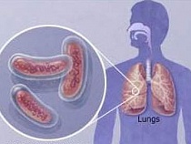 В Калининграде снизилась заболеваемость туберкулезом и сифилисом 