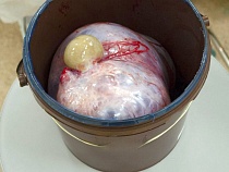 В онкоцентре из живота калининградки вырезали что-то страшное