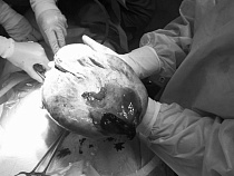 В животе 13-летней девочки из Калининграда выросла огромная опухоль  