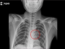 В Москве вытащили проглоченную мальчиком в Калининградской области булавку