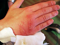 В Калининграде пенсионерка получила ожоги из-за взрыва газового котла