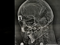 В Калининграде из-за женщины грузчик проломил голову инженеру