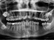 Солдату сломали челюсть за еду